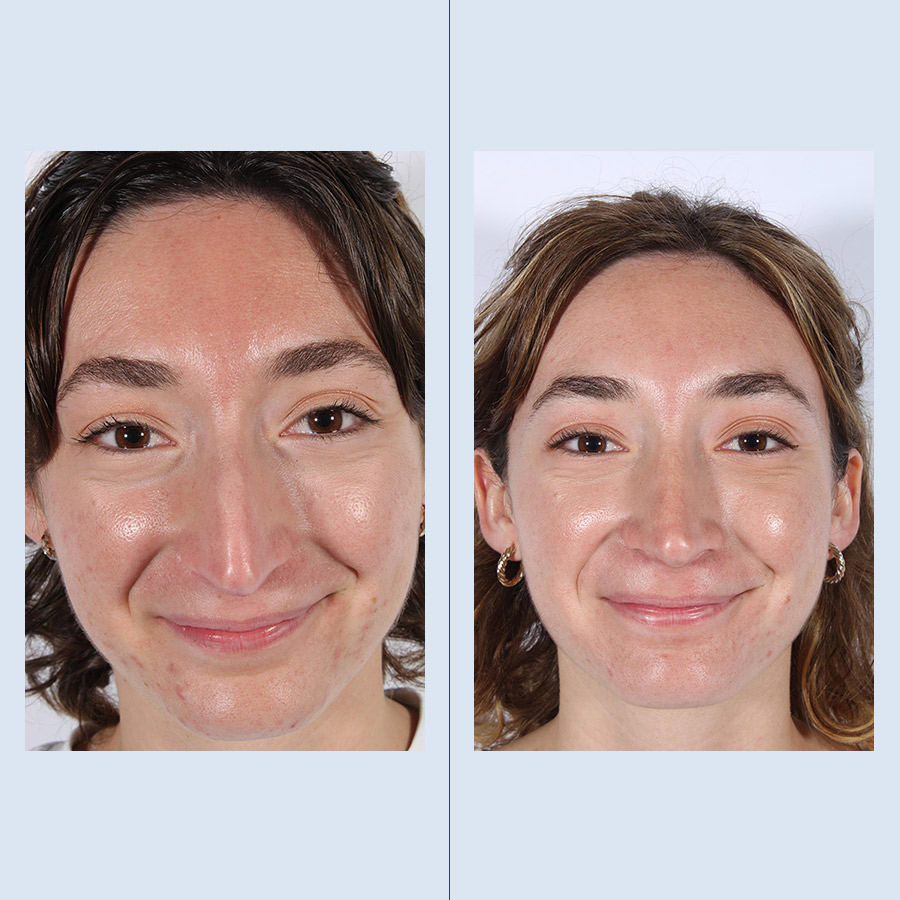 Rinoplastia Ultrasónica