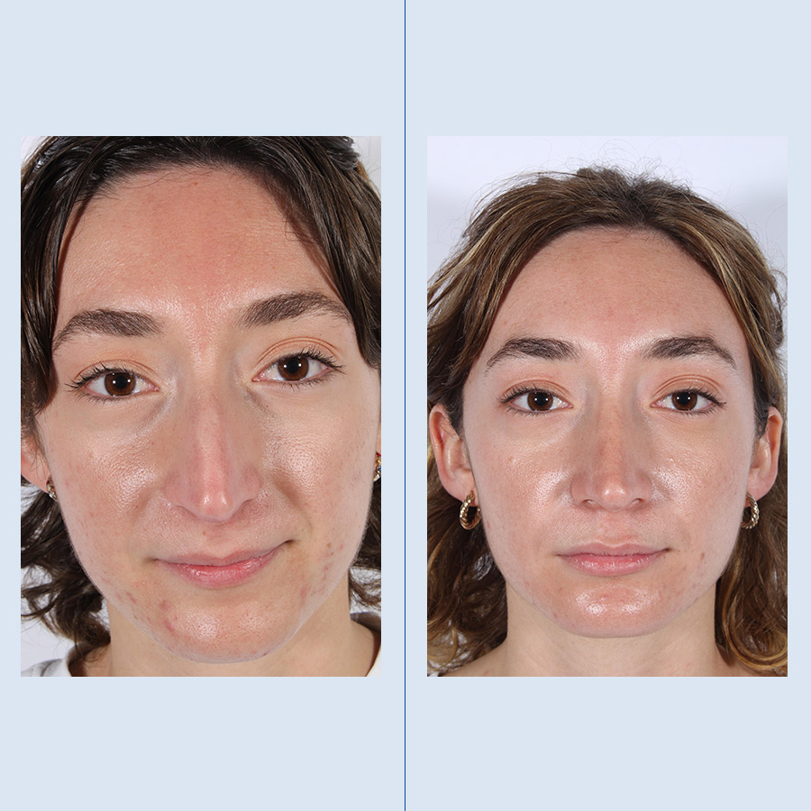 Rinoplastia Ultrasónica