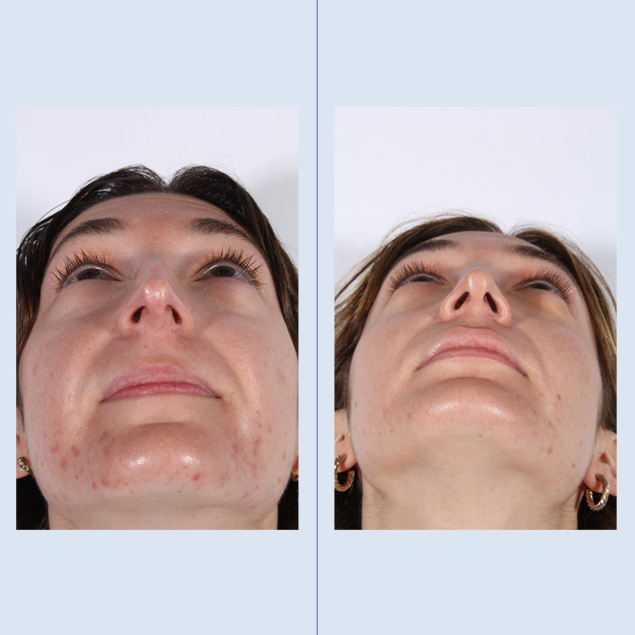 Rinoplastia Ultrasónica