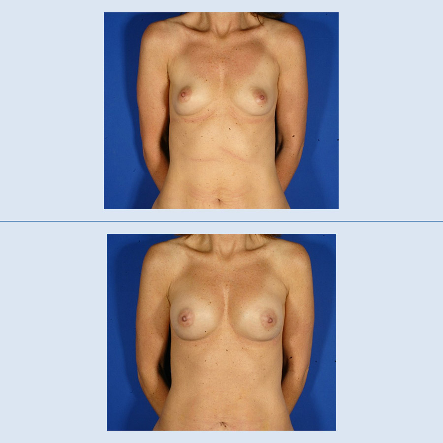 Antes y Después Breast augmentation with own fat