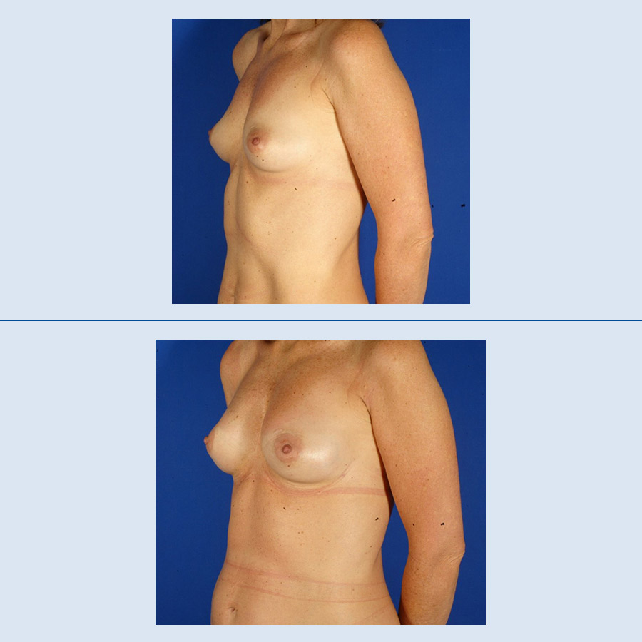 Antes y Después Breast augmentation with own fat