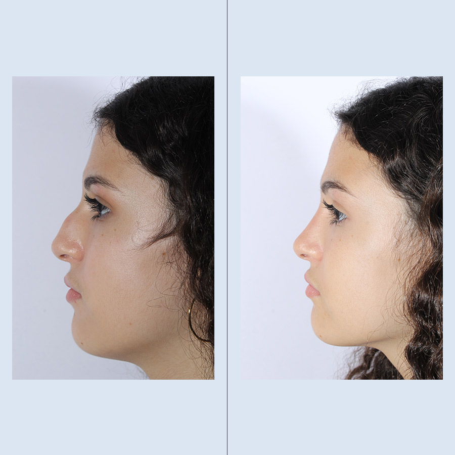 Antes y Después Rhinoplasty