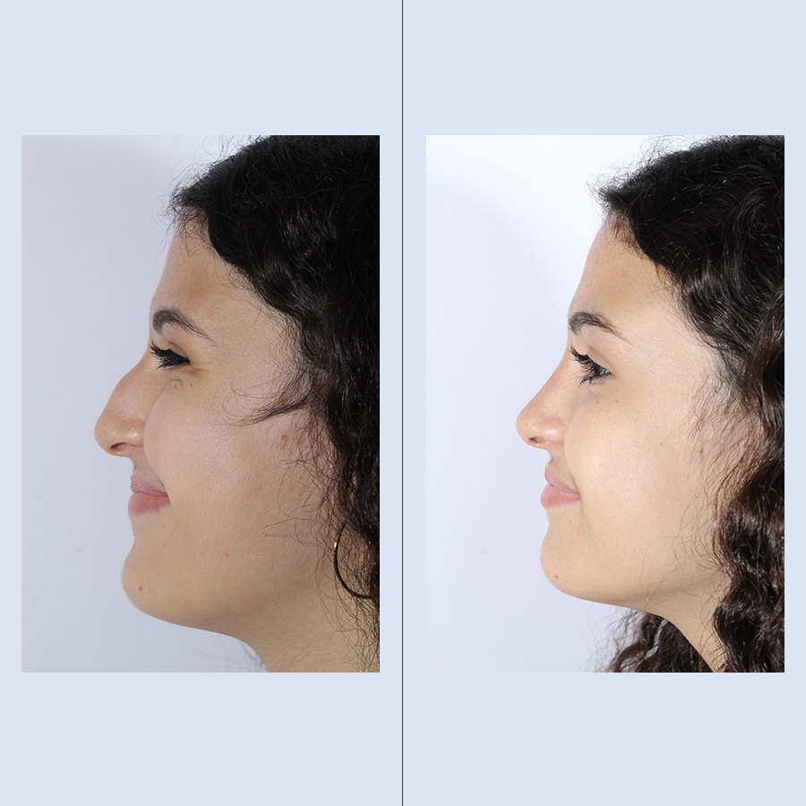 Antes y Después Rhinoplasty