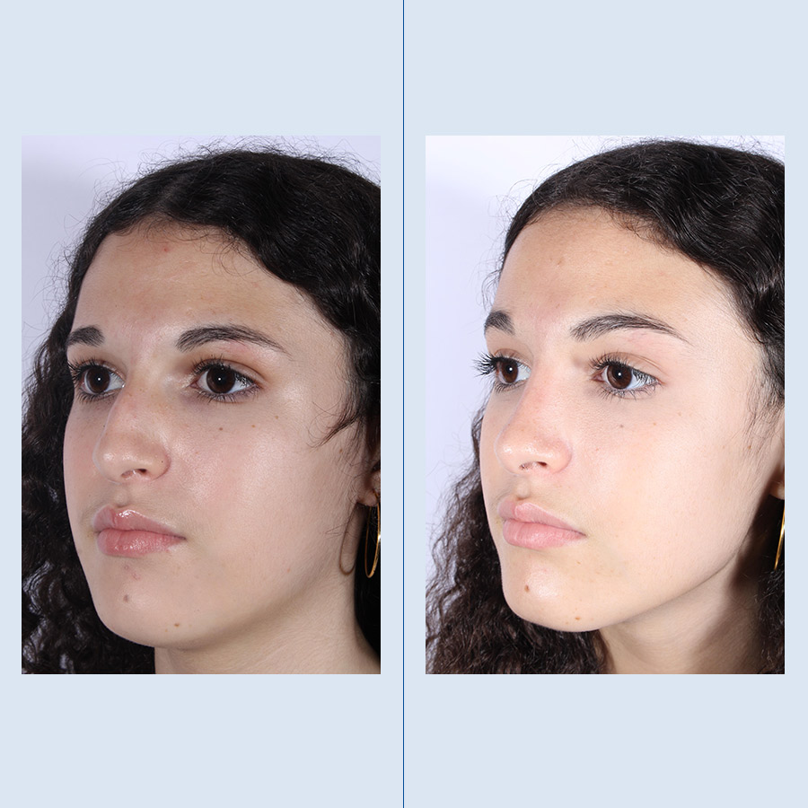 Antes y Después Rinoplastia Ultrasònica