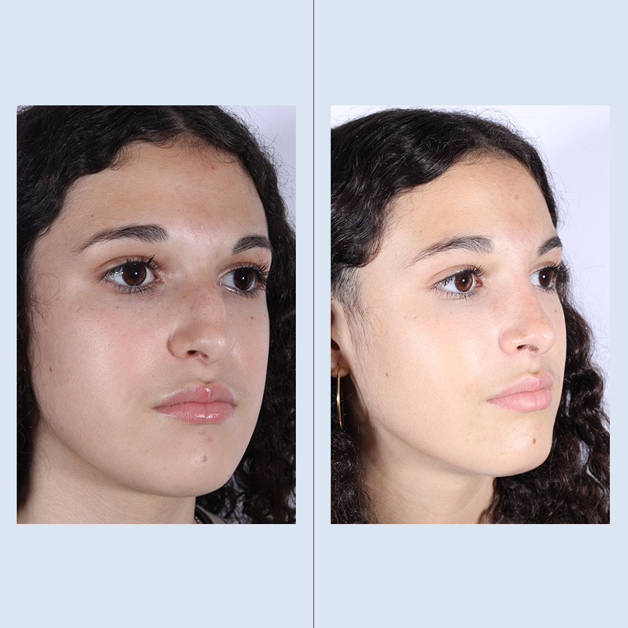 Antes y Después Rinoplastia Ultrasònica