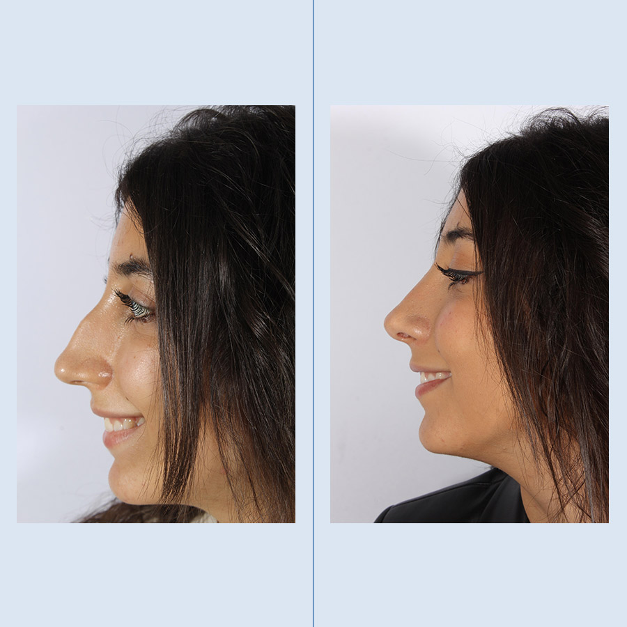 Antes y Después Rhinoplasty