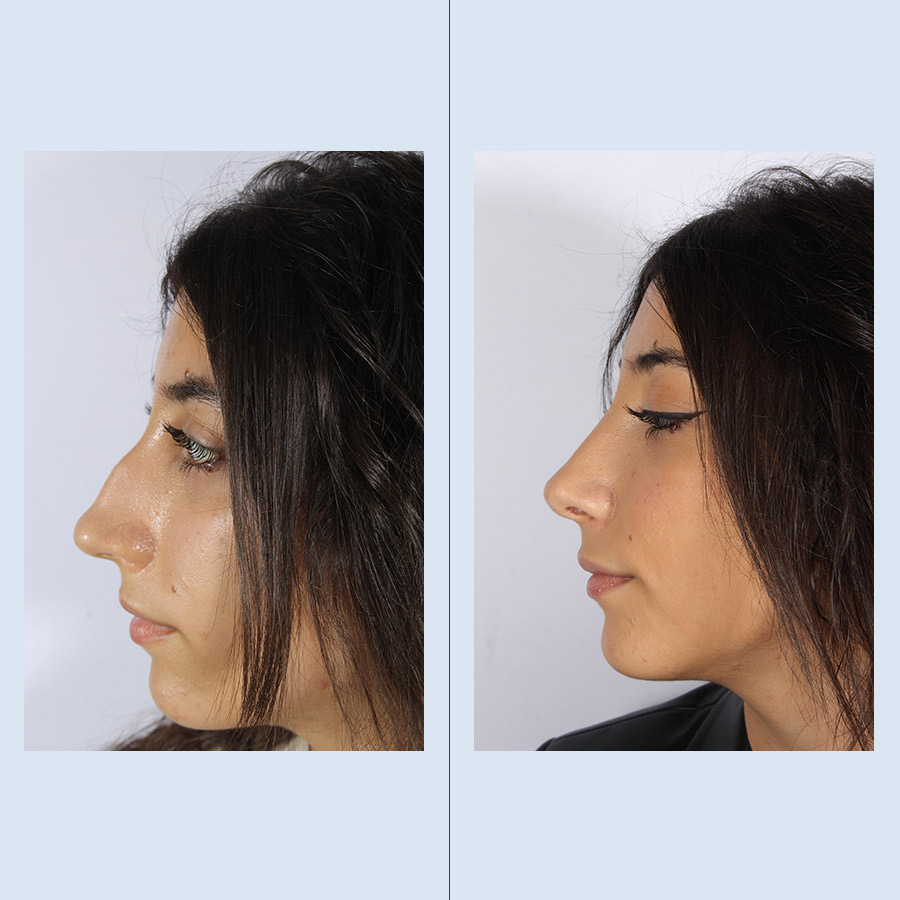 Antes y Después Septoplasty / Turbinates Surgery