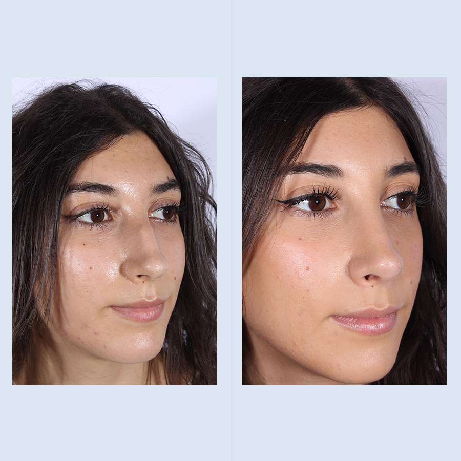 Antes y Después Ultrasonic Rhinoplasty