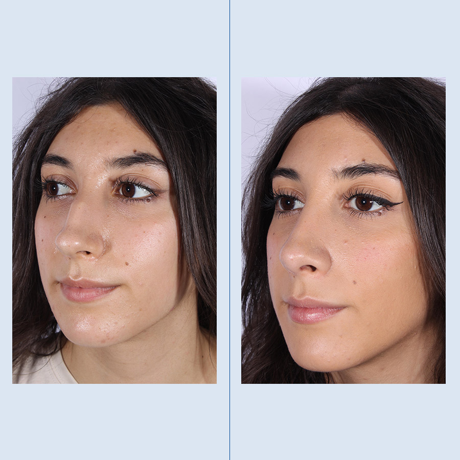 Antes y Después Septoplàstia / Cirurgia de Cornets