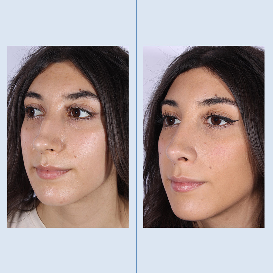 Antes y Después Ultrasonic Rhinoplasty