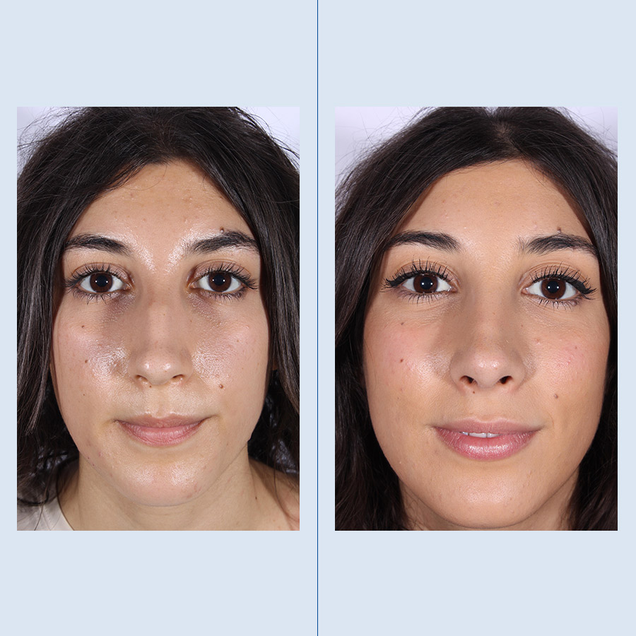 Antes y Después Ultrasonic Rhinoplasty