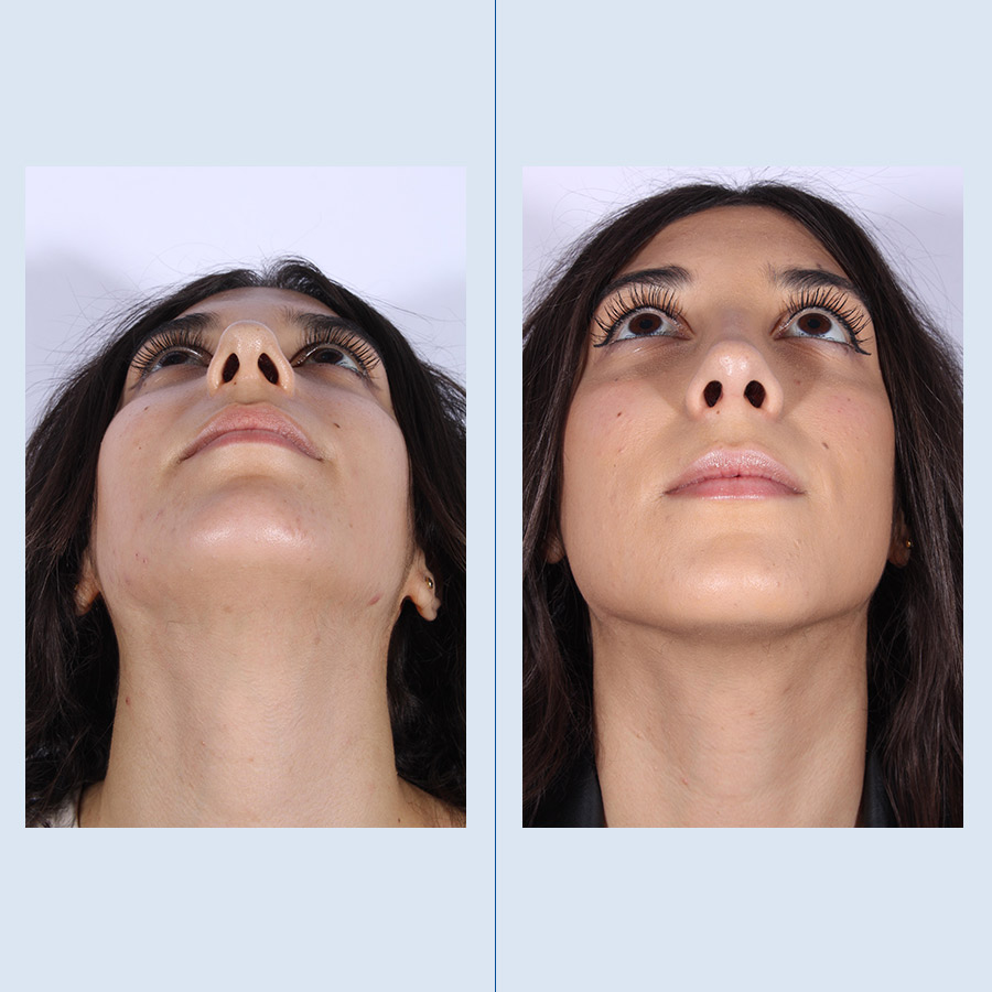 Antes y Después Septoplasty / Turbinates Surgery