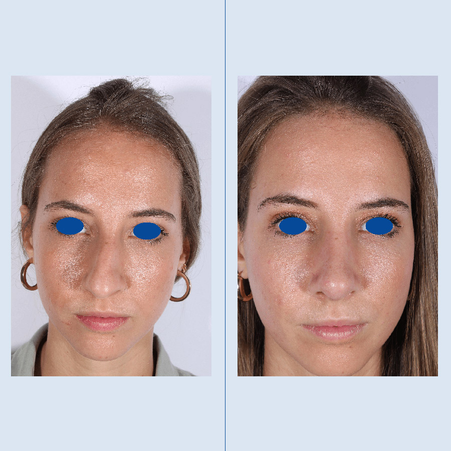 Antes y Después Ultrasonic Rhinoplasty