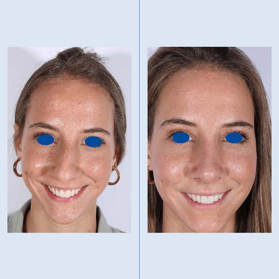 Antes y Después Rinoplastia Ultrasònica