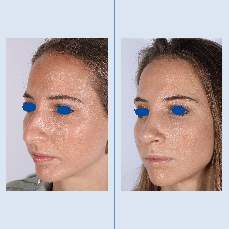 Antes y Después Ultrasonic Rhinoplasty