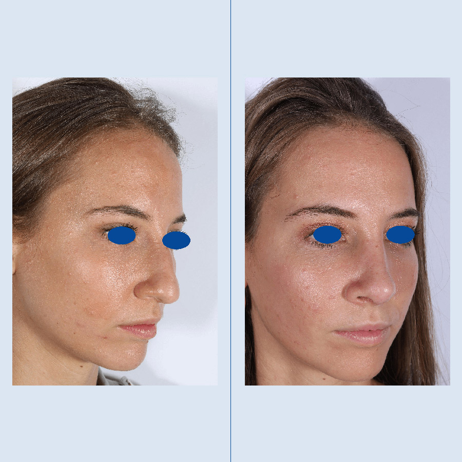 Antes y Después Rinoplastia Ultrasònica