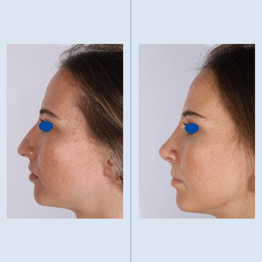 Antes y Después Rinoplastia Ultrasònica