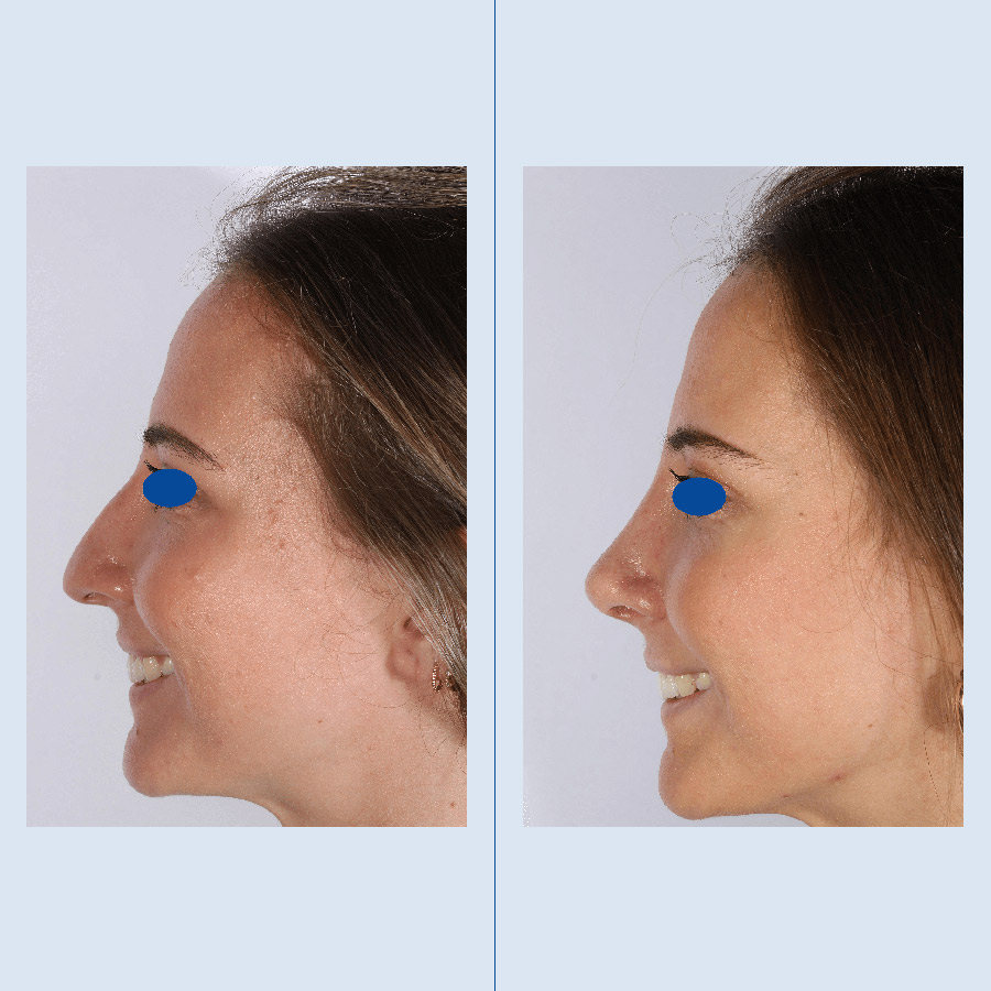 Antes y Después Septoplasty / Turbinates Surgery