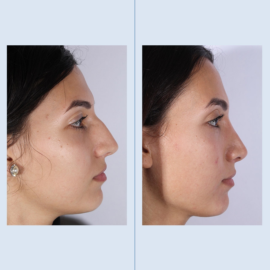 Antes y Después Rhinoplasty