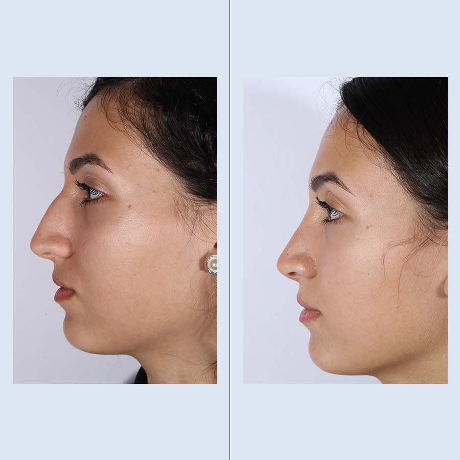 Antes y Después Rinoplastia Ultrasònica