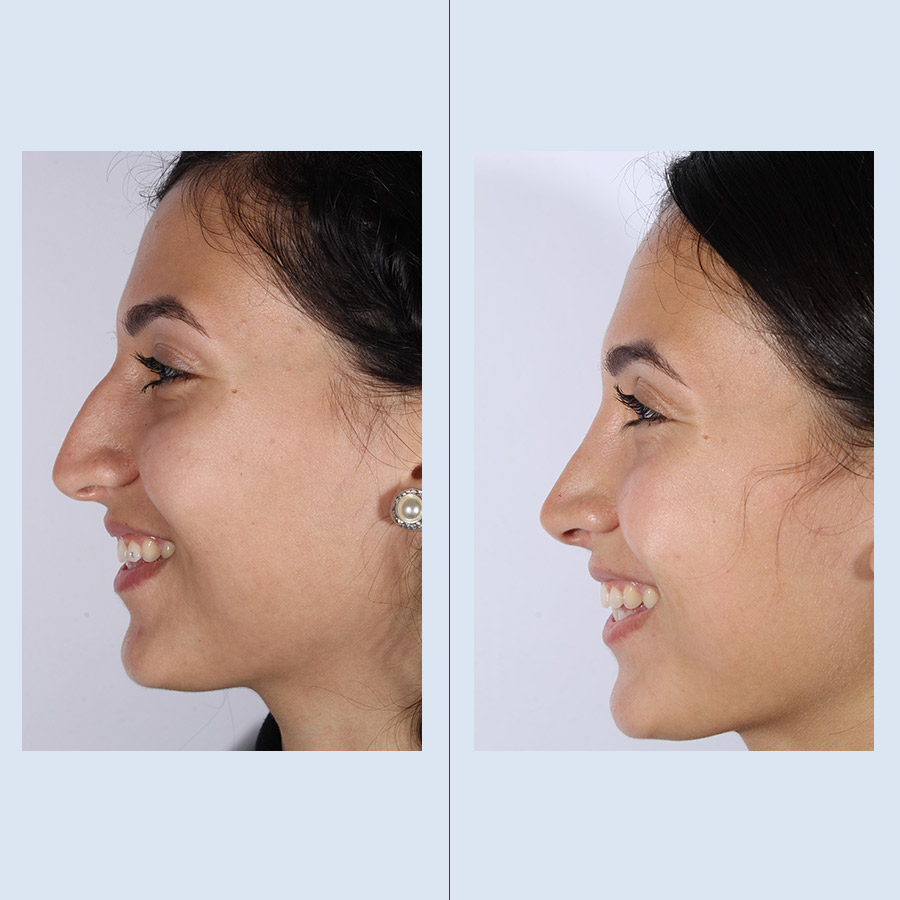 Antes y Después Rhinoplasty