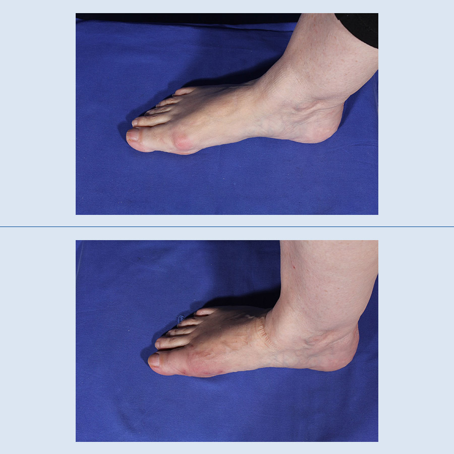 Antes y Después Bunions