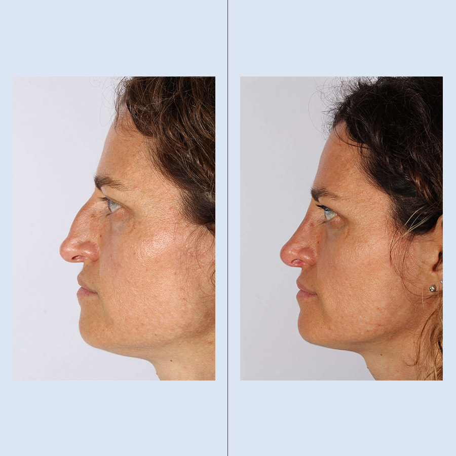 Rinoplastia Ultrasónica