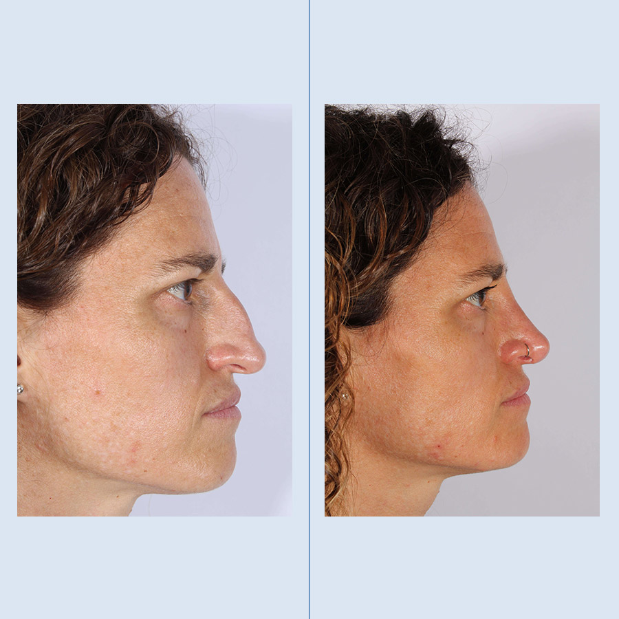 Antes y Después Rhinoplasty