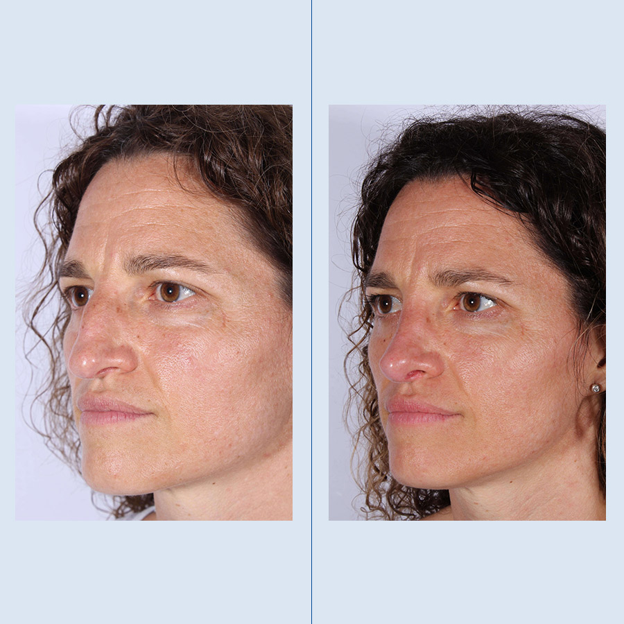 Antes y Después Ultrasonic Rhinoplasty