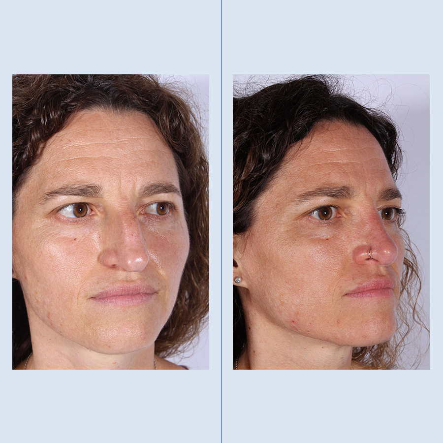 Antes y Después Ultrasonic Rhinoplasty