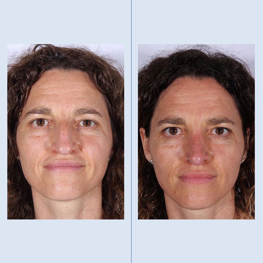 Antes y Después Ultrasonic Rhinoplasty