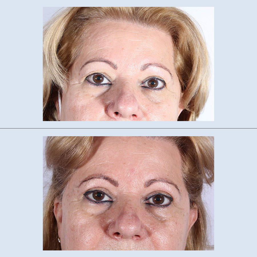 Antes y Después Blepharoplasty