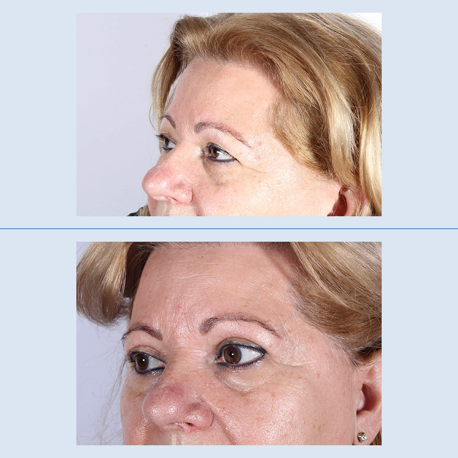 Antes y Después Blepharoplasty