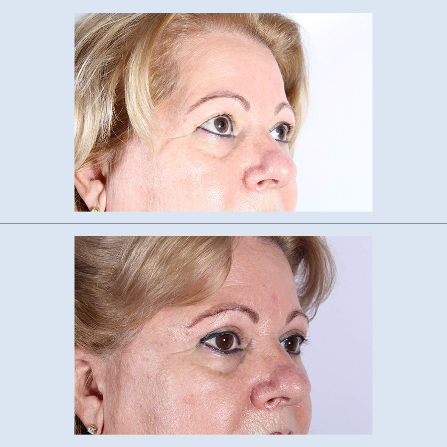 Antes y Después Blepharoplasty