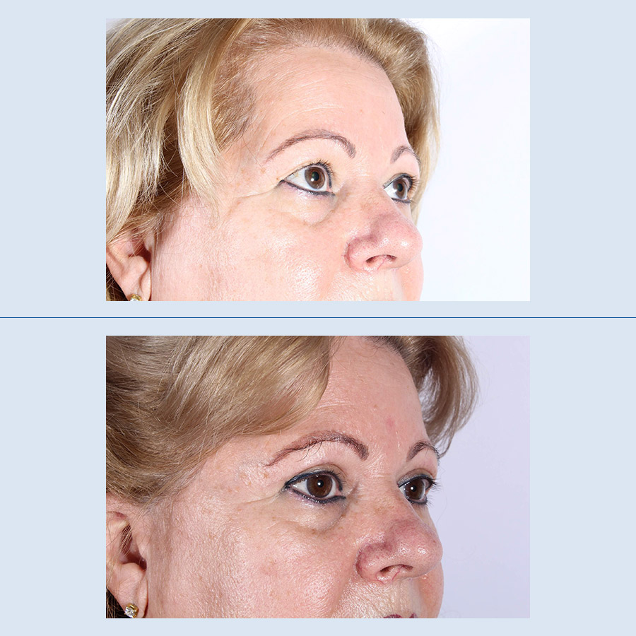 Antes y Después Cirurgia de les parpelles