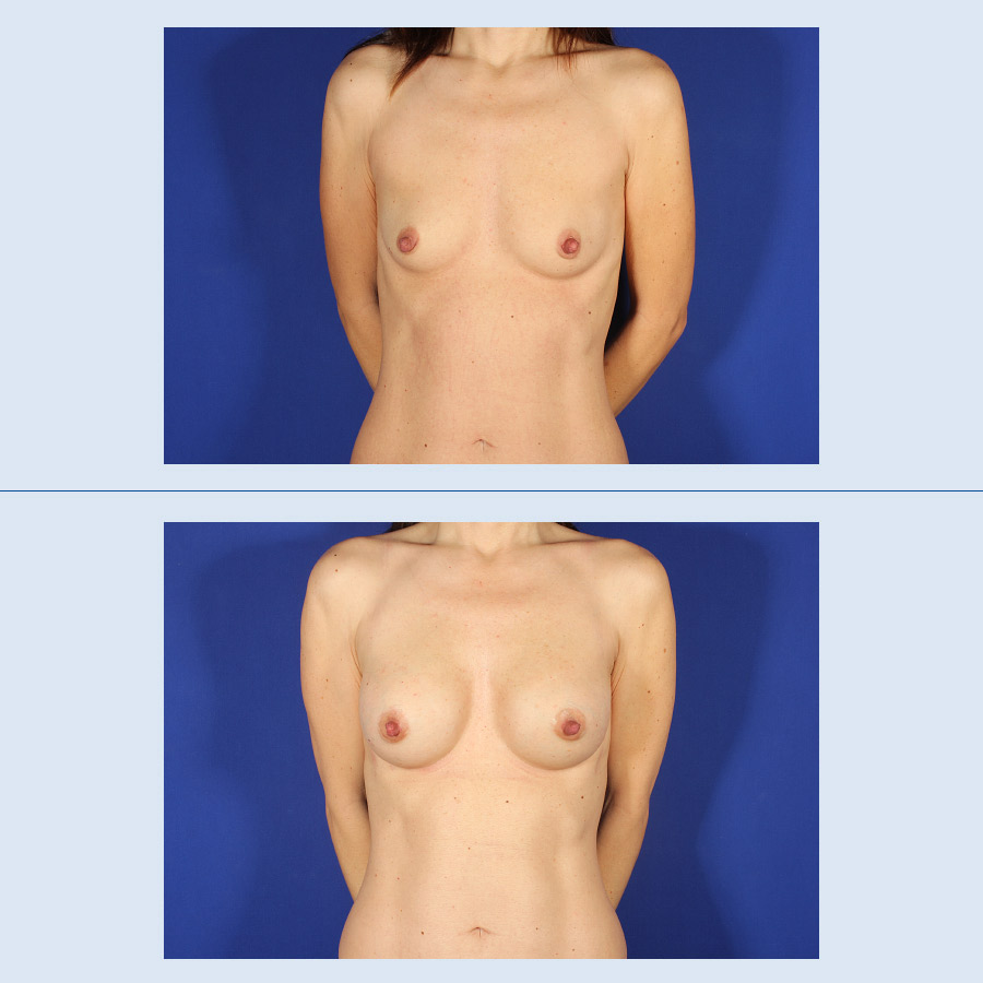 Antes y Después Augment de mames amb pròtesi