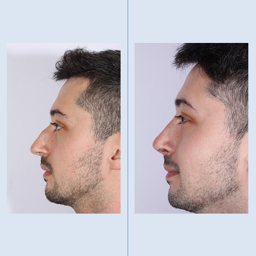 Antes y Después Rinoplastia Ultrasònica