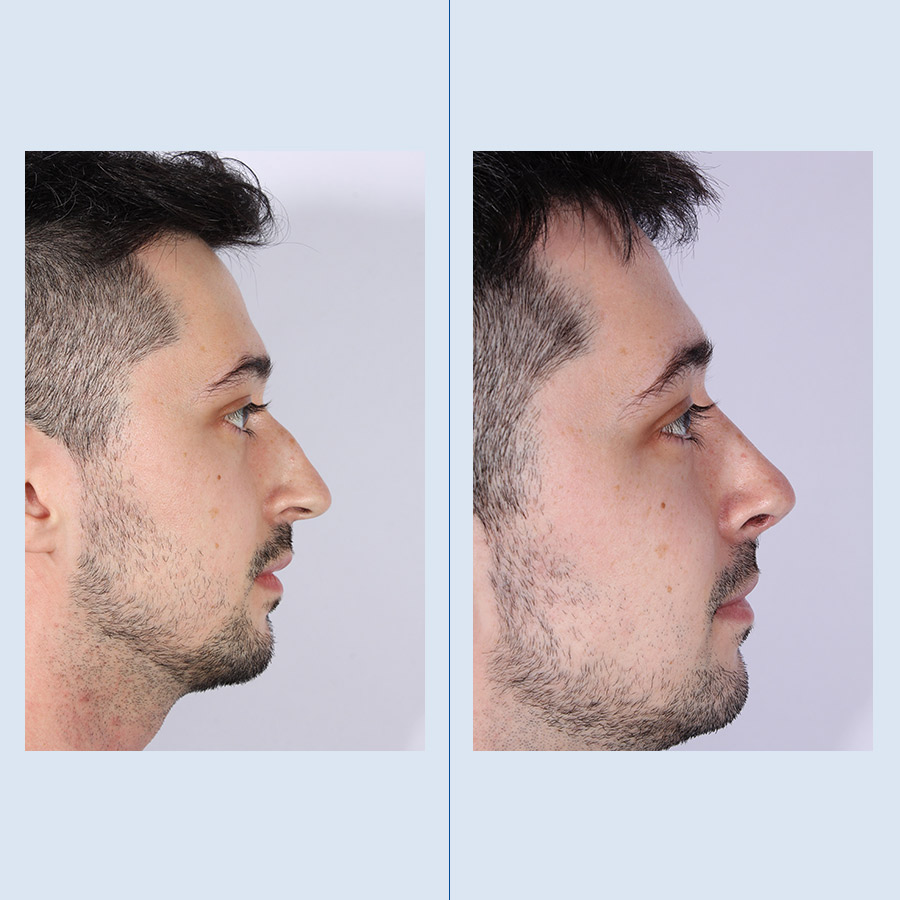 Antes y Después Cirurgía del nas