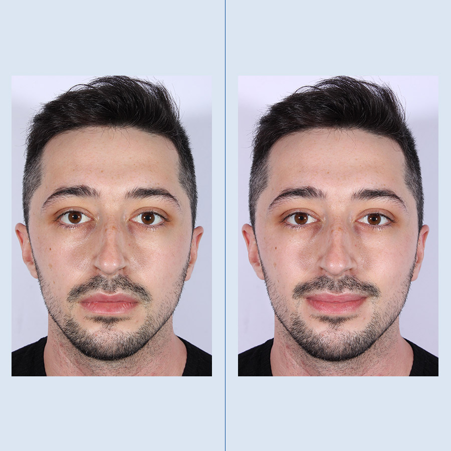 Antes y Después Ultrasonic Rhinoplasty