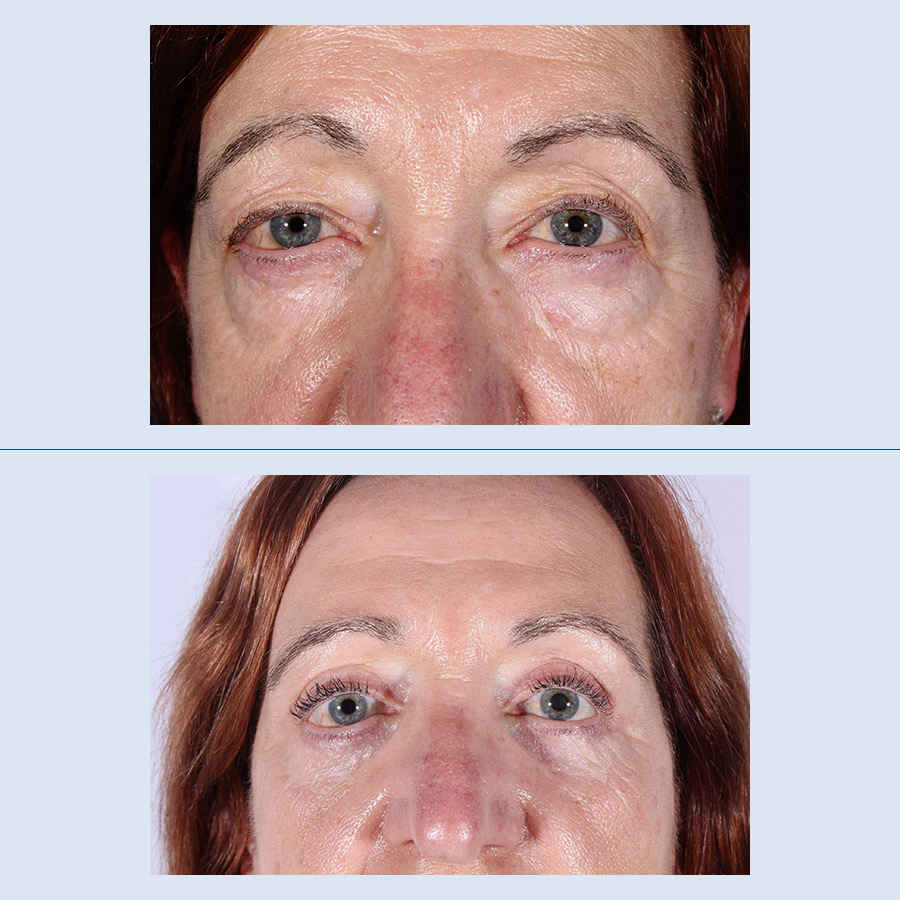 Antes y Después Blepharoplasty