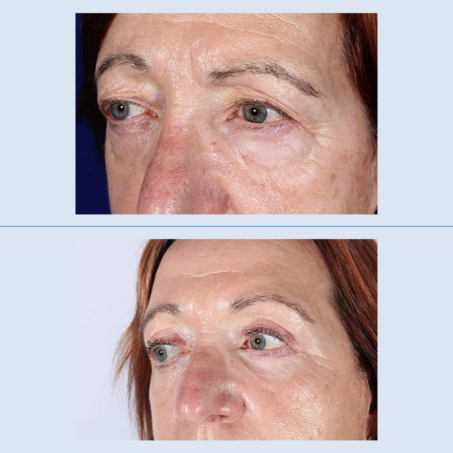 Antes y Después Blepharoplasty