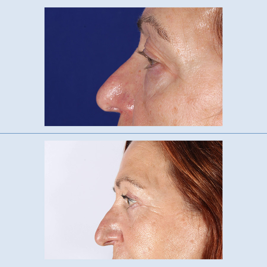 Antes y Después Blepharoplasty