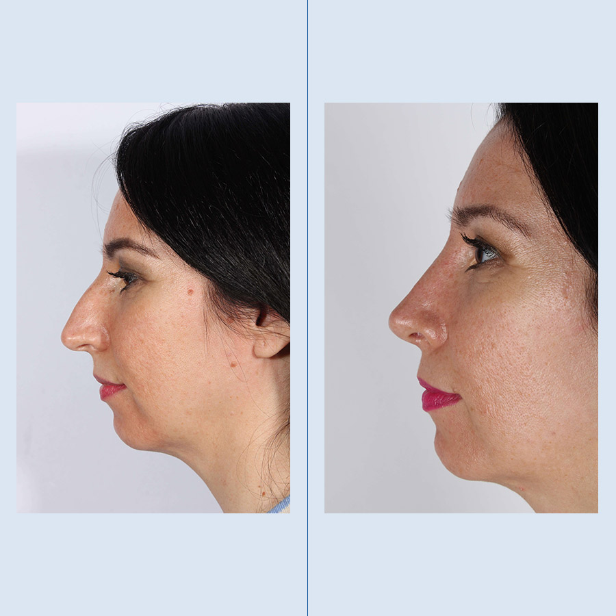 Antes y Después Septoplasty / Turbinates Surgery