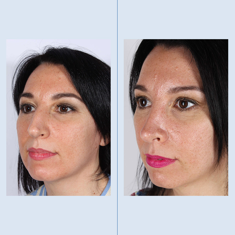 Antes y Después Septoplasty / Turbinates Surgery