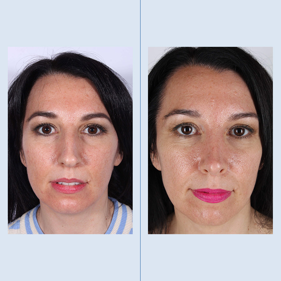 Antes y Después Septoplasty / Turbinates Surgery