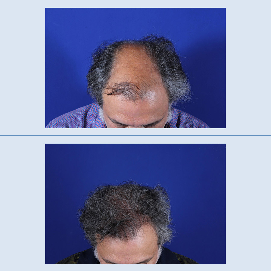 Antes y Después Hair micro-grafts