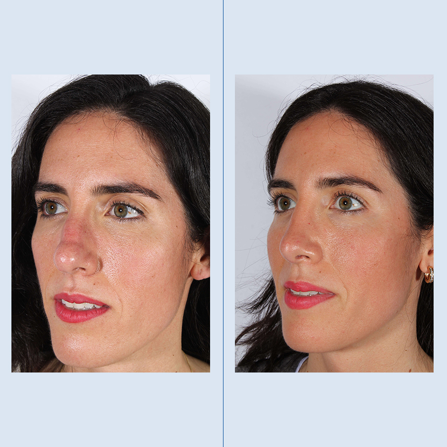 Rinoplastia Ultrasónica