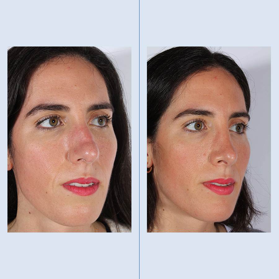 Rinoplastia Ultrasónica