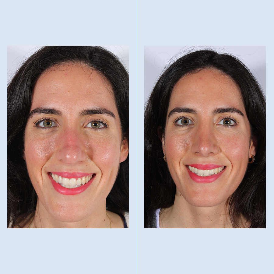 Antes y Después Rhinoplasty