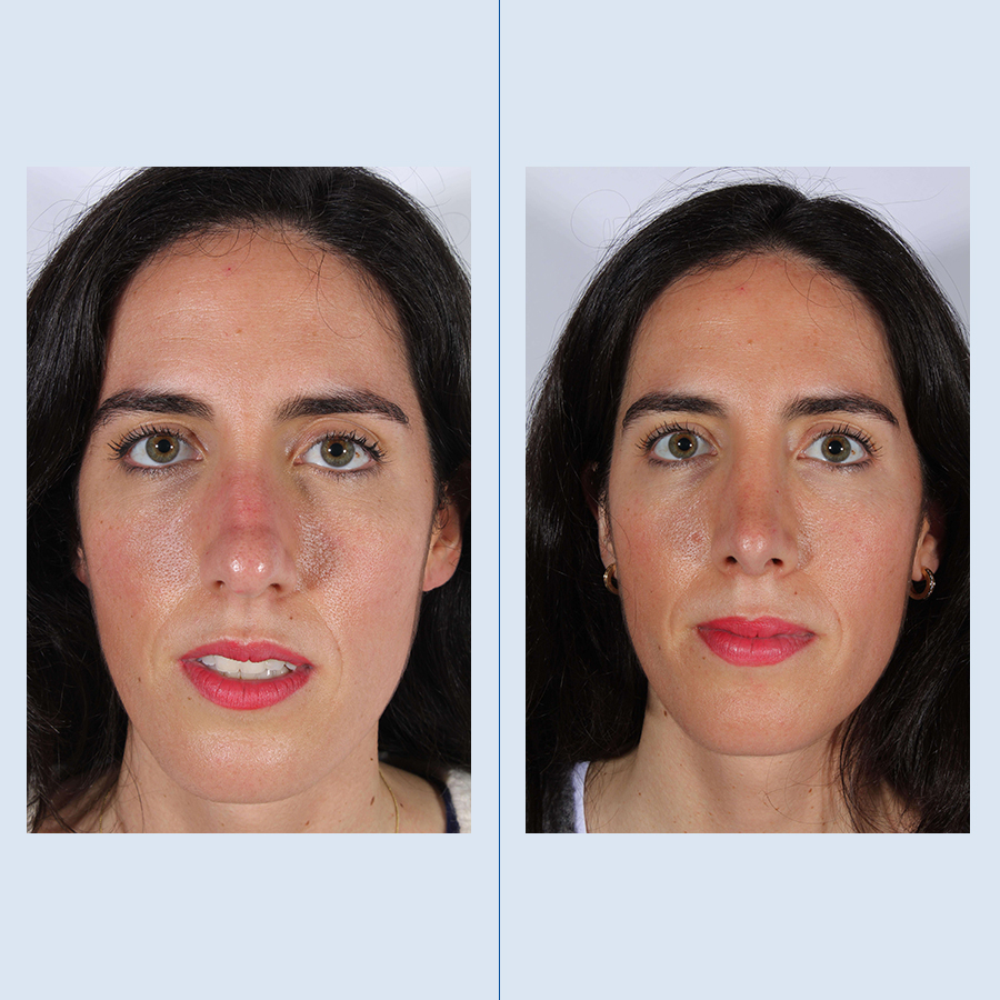 Antes y Después Rhinoplasty